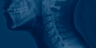 A blue image of a person with a spinal cord injury.