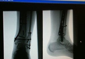 A picture of an x-ray and a photo of someone 's foot.