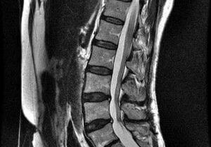 A black and white photo of the back end of a spinal column.